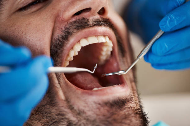 Best Emergency Treatment for Dental Infections or Abscesses in Kensington, CT