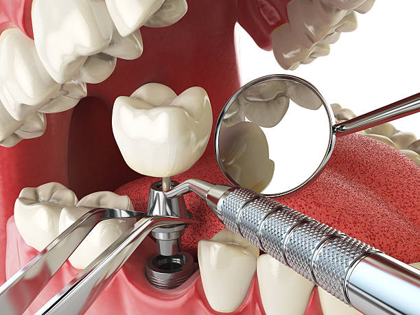 Best Emergency Wisdom Teeth Removal in Kensington, CT